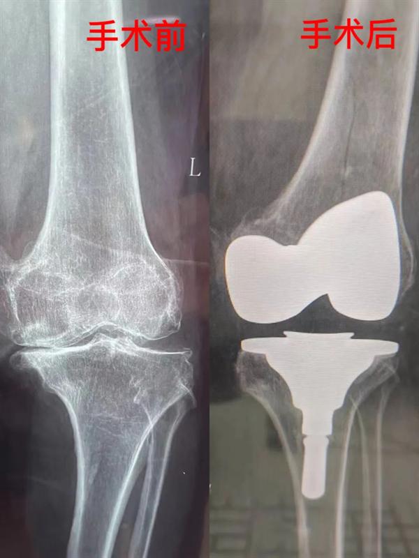 精准治疗自由行走——鲁山二院骨外科成功开展膝关节置换术_中国网客户端